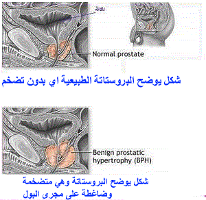 prostat02